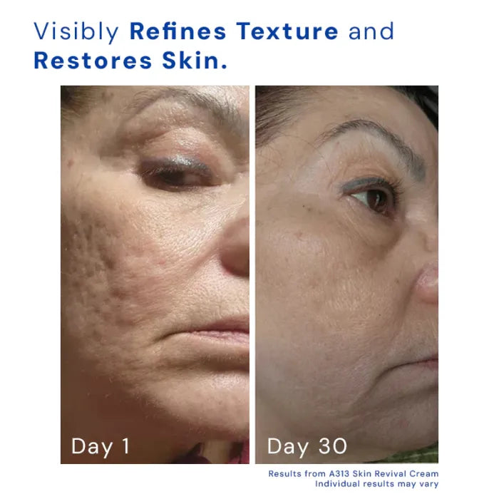 A313 Retinol Skin Removal Cream
