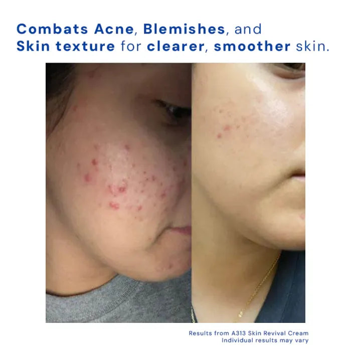 A313 Retinol Skin Removal Cream